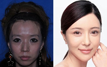 Những ca phẫu thuật thẩm mỹ "gây choáng váng" của phụ nữ Trung Quốc - 13 Mi Vân