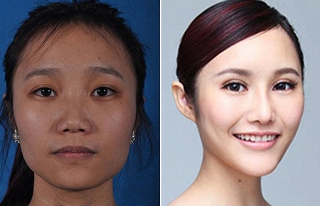 Những ca phẫu thuật thẩm mỹ "gây choáng váng" của phụ nữ Trung Quốc - 14 Mi Vân
