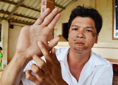 Nạn nhân và quyết định không khởi tố vụ án của Công an TX Vĩnh Châu.