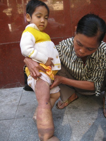 Cô bé "chân voi" ăn xin cầu sự sống - 1 Cô bé "chân voi" ăn xin cầu sự sống - 1