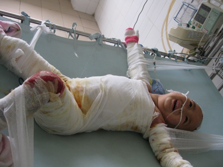 Xót thương bé thơ 4 tuổi bị bỏng nặng - 2 Xót thương bé thơ 4 tuổi bị bỏng nặng - 2