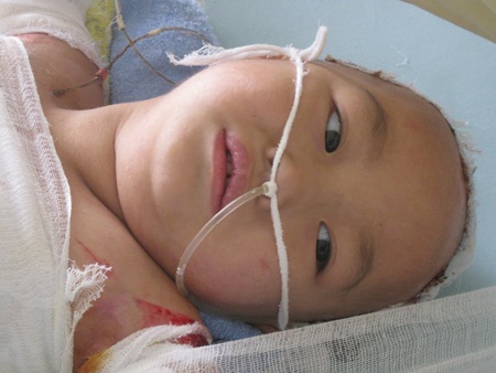 Xót thương bé thơ 4 tuổi bị bỏng nặng - 4 Xót thương bé thơ 4 tuổi bị bỏng nặng - 4