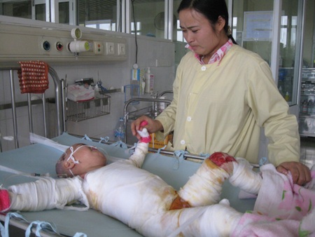 Xót thương bé thơ 4 tuổi bị bỏng nặng - 1 Xót thương bé thơ 4 tuổi bị bỏng nặng - 1