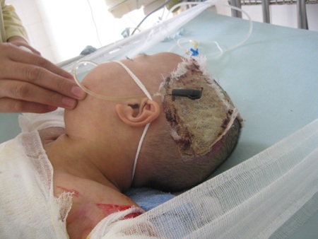 Xót thương bé thơ 4 tuổi bị bỏng nặng - 3 Xót thương bé thơ 4 tuổi bị bỏng nặng - 3