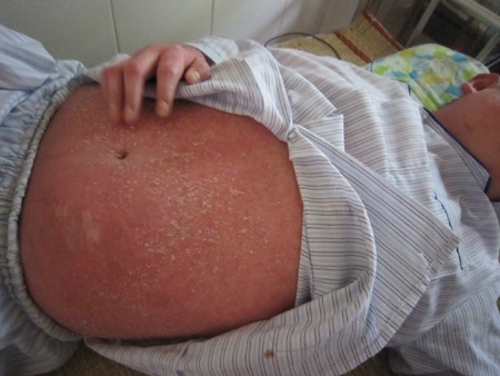 Toàn thân em bị phù nề, ửng đỏ và có mủ