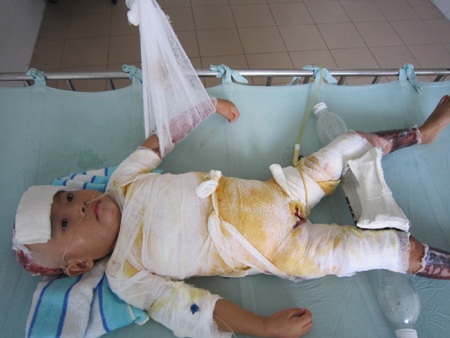 Hơn 600 triệu đồng đến với các em bé bị bỏng nặng - 1 Với tính trạng nặng, hiện tại bé Huyền vẫn đang được điều trị tại khoa Hồi sức cấp cứu