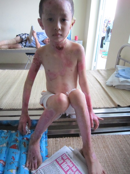 Hơn 600 triệu đồng đến với các em bé bị bỏng nặng - 3 Đã qua giai đoạn nguy hiểm, ít ngày nữa em sẽ được trở về nhà để nhập học lớp 1