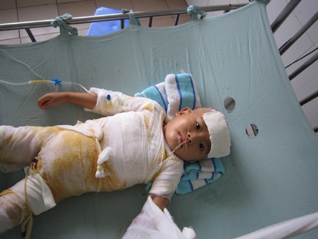 Hơn 600 triệu đồng đến với các em bé bị bỏng nặng - 2 Dù chịu nhiều đau đớn nhưng Huyền không bao giờ khóc khiến ai cũng xót lòng