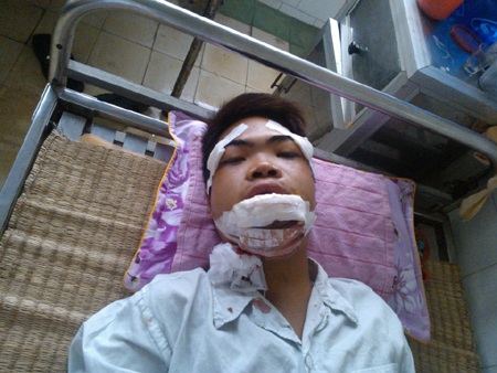 Bị tai nạn xe máy, Thành phải nhập viện trong tình trạng gãy hai hàm