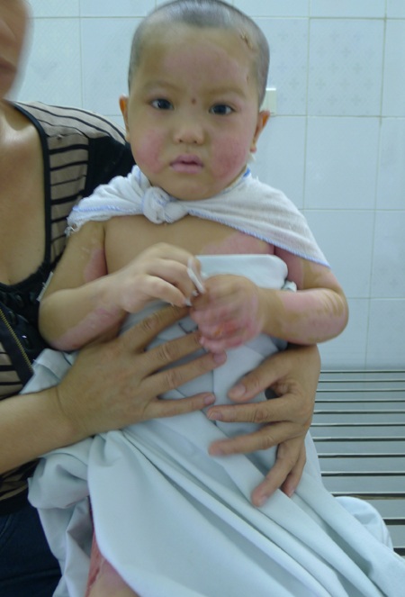 Hơn 100 triệu đồng đến với hai anh em bị bỏng rơm