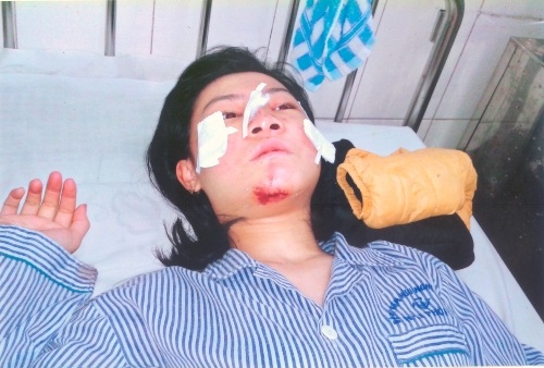 Vụ tai nạn khiến cháu Hằng bị gẫy xương mũi, xương hàm và những tổn thương khác