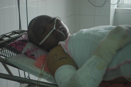 Với diện tích bỏng là 55% trong đó có 44% bỏng sâu,