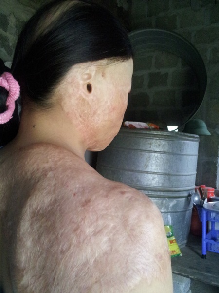 Vụ tai nạn bất ngờ cướp đi khuôn mặt của chị