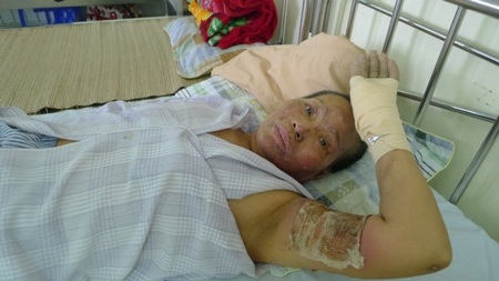 Đã qua giai đoạn nguy hiểm nên bà Vẻ đã được chuyển sang điều trị tại khoa Phục hồi chức năng