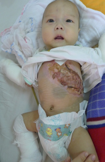 Bệnh li thượng bì bóng nước khiến cả cơ thể của bé Tùng bị bong tróc đau đớn