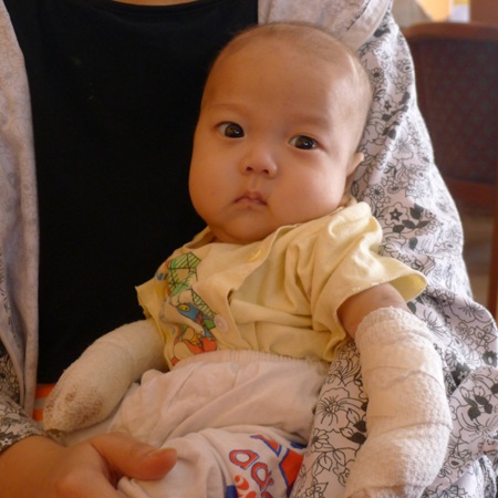 Mới 5 tháng tuổi, bé Tùng bị li thượng bì bóng nước bẩm sinh nên phải điều trị tại bệnh viện Nhi TW