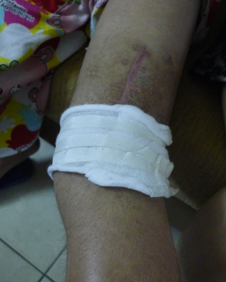 Vết thương ở chân cũng đã đỡ hơn nhiều, tuy nhiên để đi lại được em vẫn phải dùng nạng