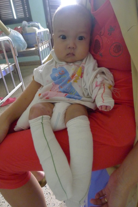 Tình hình bệnh của bé Tùng đã khá hơn nhiều kể từ khi được bạn đọc Dân trí giúp đỡ 