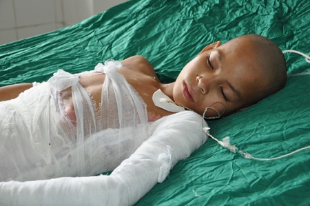 Bị 25% bỏng sâu độ 3,4, tình trạng của bé Phủ hết sức nguy kịch