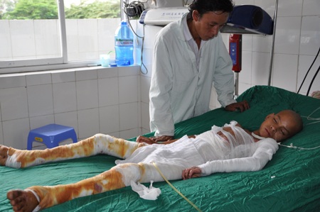 Bị bỏng xăng đến 70% cả cơ thể bé Phủ bị băng trắng hết 