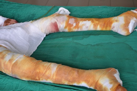 Tai nạn bỏng xăng khiến cho cơ thể bé Phủ bị tổn thương nghiêm trọng 