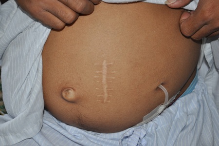 Bị suy thận mãn nên anh Tráng phải tiến hành lọc màng bụng