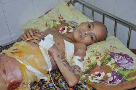 Hơn 82 triệu đến với em bé dân tộc Phù Lá bỏng xăng