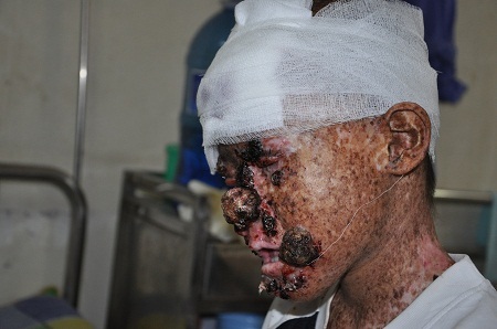 Em được kết luận bị ung thư da tại bệnh viện.