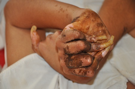 Phần da ngoài bong tróc, chảy máu khiến em đau đớn.