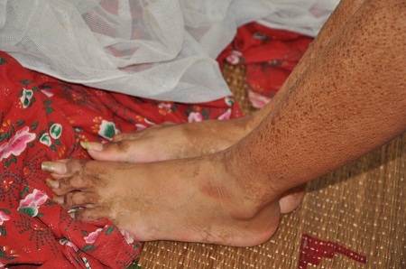 Căn bệnh khiến đôi chân của em cũng trở nên không bình thường.