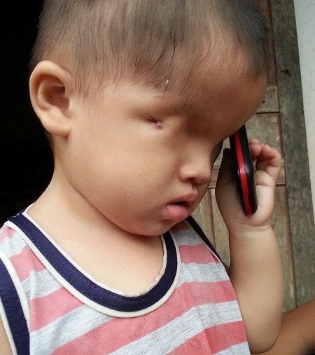 Lại thêm một bé 2 tuổi đáng thương khiếm khuyết... "cửa sổ tâm hồn" - 1 Không có ai chơi cùng, cậu bé Lâm (2 tuổi) chỉ có chiếc điện thoại làm bạn.