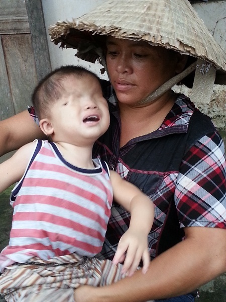 Lại thêm một bé 2 tuổi đáng thương khiếm khuyết... "cửa sổ tâm hồn" - 3 Chị Ngô Thị Loan cho biết, sinh con ra Lâm đã không có mắt như bao đứa trẻ khác.