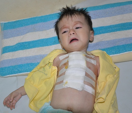 Vừa trải qua ca mổ tim nhưng bé Sỹ bị viêm phổi nặng nên phải điều trị tích cực.