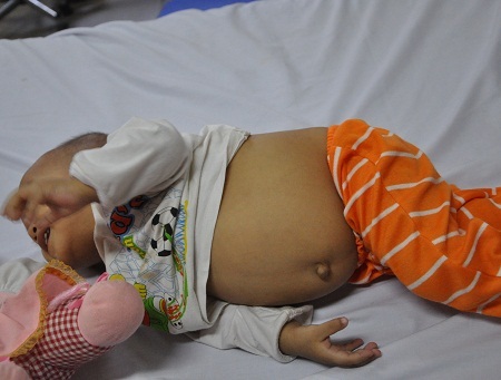 13 tháng tuổi, bé Bình mắc chứng bệnh ung thư dạng hiếm gặp. 