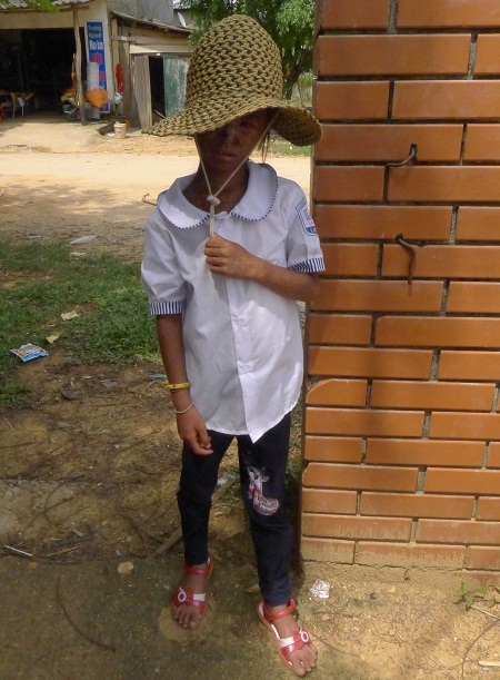 Ước mơ có được một khuôn mặt bình thường đến bao giờ mới thành hiện thực với cô bé này?