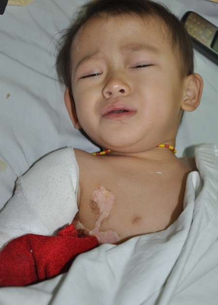 Bị bỏng nước sôi, tính mạng của bé Sao đang hết sức nguy kịch.