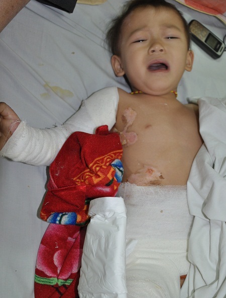 Bé Sao đã được mổ một lần, sắp tới ít nhất em phải mổ lần nữa.