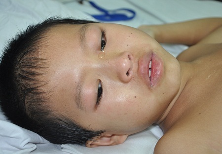 Vừa trải qua ca phẫu thuật cách đây 3 ngày khiến bé Minh còn đau đớn nhiều.