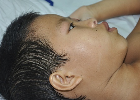 8 tuổi em còn quá ngây thơ và non dại khi phải đối diện với căn bệnh nguy hiểm.