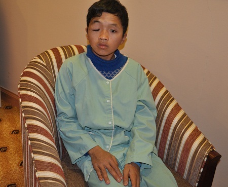 Bị u xơ thần kinh tuyến mắt khiến mi mắt phải của em sụp xuống gần như không còn nhìn thấy gì nữa.