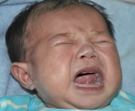 Hơn 2 tháng tuổi bé Minh Nhật phát hiện bị tim bẩm sinh nặng nên cần mổ gấp.