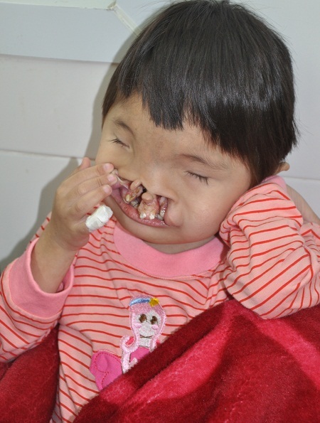 Được sự giúp đỡ của nhiều bạn đọc Dân trí, cậu bé Tự đã bắt đầu đi chữa bệnh.