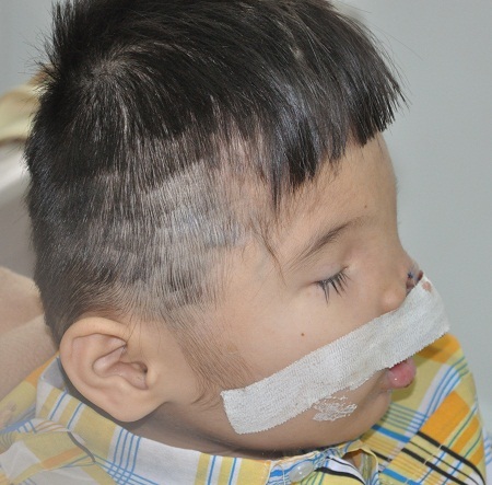 Tự đi đa dị tật phức tạp nên em sẽ phải can thiệp phẫu thuật thêm nhiều lần nữa.