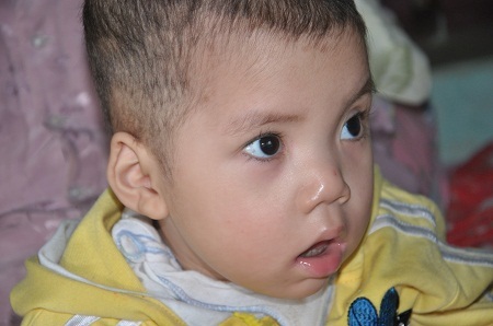 Bé 2 tuổi bị rối loạn chuyển hóa bẩm sinh đã không còn