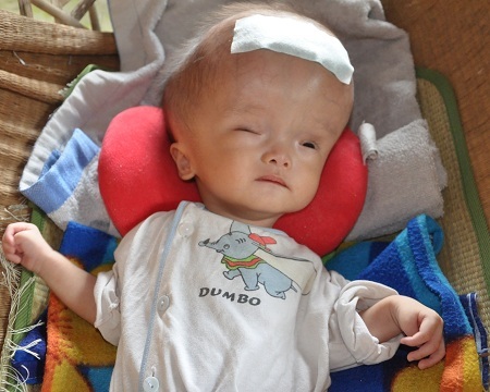 Thương bé 5 tháng tuổi bị não úng thủy và tim bẩm sinh | Báo Dân trí