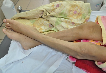 Khiến cơ thể trở nên tong teo, tiều tụy.