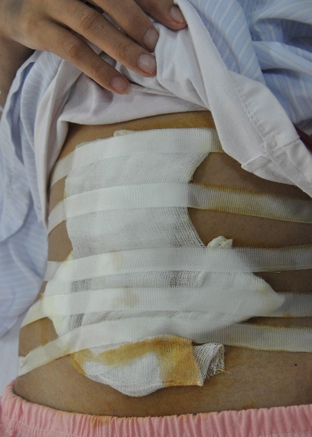 Vết mổ vì bị vỡ buồng trứng cách đây không lâu của Hoa.