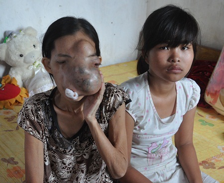 Khối u ngày càng to trên khuôn mặt chị Tuyết.