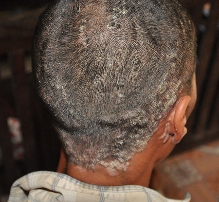 Từ nhỏ, anh Chiến đã bị lở loét hết vùng đầu và tai chảy mủ, sức khỏe kém.