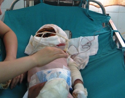 Cháu bé bị bố tẩm xăng thiêu sống đã được ghép da    - 1